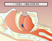 1. 기도열기(입 안의 이물 제거)