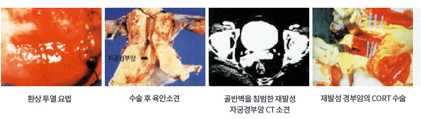 재발성 자궁경부암의 치료