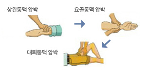 상완동맥압박, 요골동맥압박, 대퇴동맥압박하는 이미지