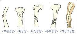 부전골절, 횡골절, 나선골절, 분쇄골절, 개방성골절 이미지 