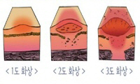 1도화상, 2도화상, 3도화상 이미지