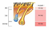 표피 1도화상, 진피 2도화상, 피하지방 3도화상 이미지